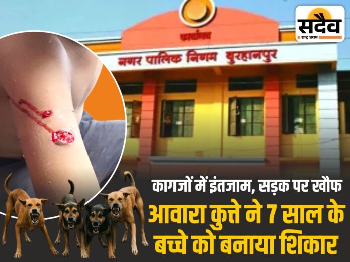 बुरहानपुर में आवारा कुत्ते के हमले में घायल 7 वर्षीय बच्चा